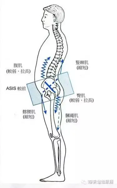 下交叉综合症图解图片