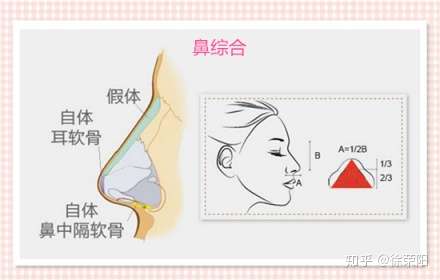 怎么避免隆鼻术后产生包膜挛缩呢 知乎