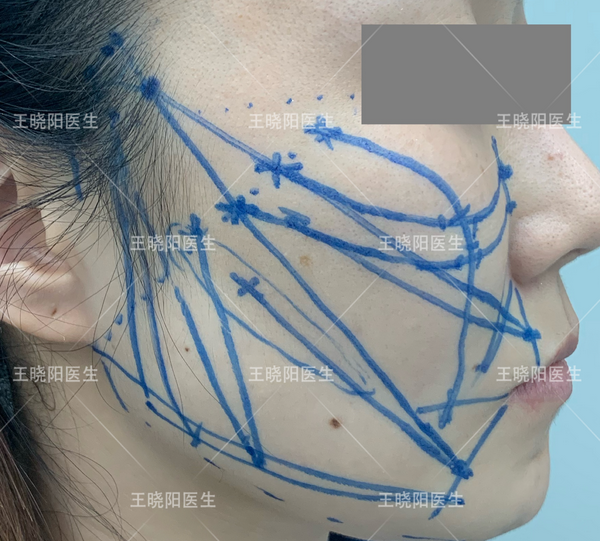 整形外科王晓阳医生 的想法: 颞区的层次较多,从浅至深分为七层,包括… - 知乎