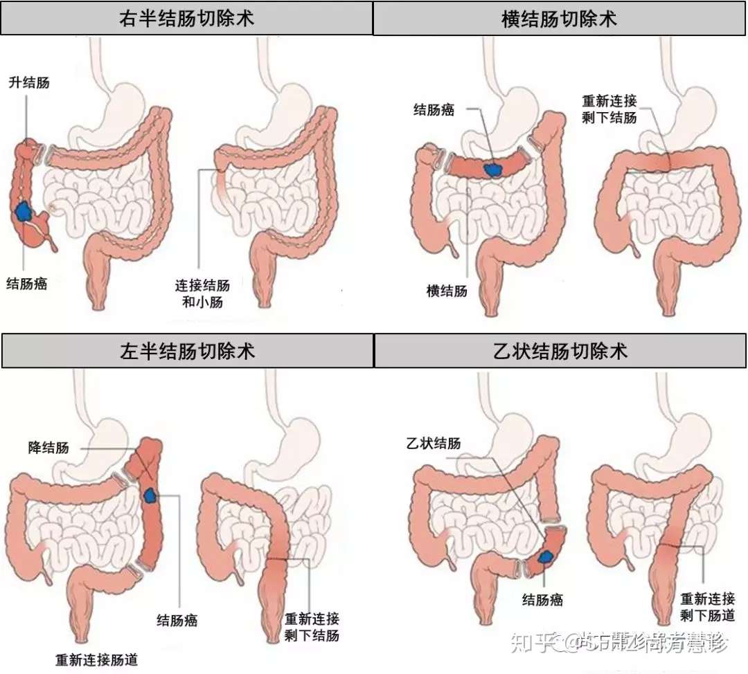 一文读懂结肠癌的手术治疗 知乎