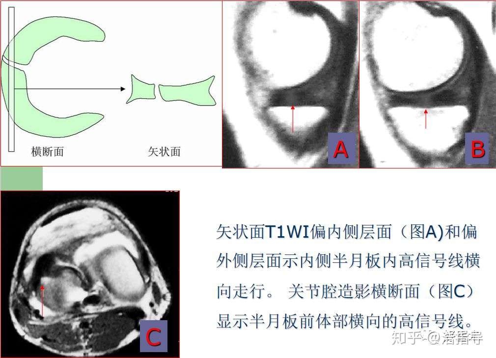 膝关节半月板损伤核磁诊断要点详解与治疗分析 知乎