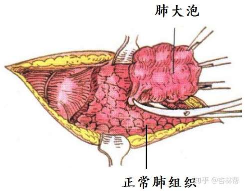 肺大疱的手术适应症有哪些 术后会复发吗 胸外专家王科平 知乎