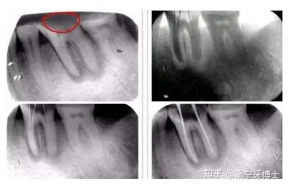 警惕根管治療不做冠牙齒遲早留後患