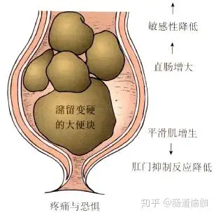 如果你便秘,一定要知道这些