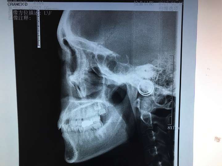 泻药,最好拍一下,虽然医生通过经验可以判断个大概,比如见到牙齿后,大