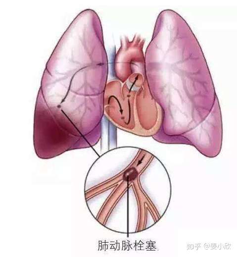 胸痛 憋气 别只想着 心梗 肺栓塞这个病凶险至极 王丽艳 知乎