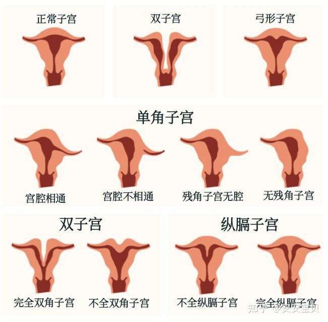 单角子宫能否怀孕 知乎