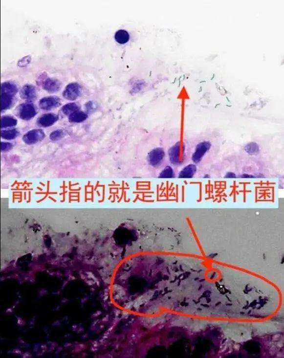 幽门螺杆菌检测方法大揭秘:是呼气试验准,还是胃镜准确?