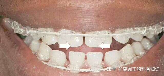 北京牙齿矫正哪家好 牙齿矫正会老来早掉牙 反了 矫正使得晚掉牙 知乎