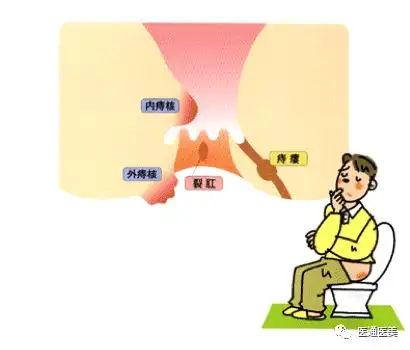 2)肛瘻:肛門內部齒狀線的縫隙中由於細菌感染而化膿,化膿處破裂而形成