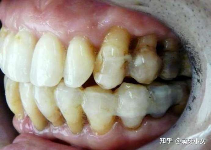 早期牙龈萎缩图片图片