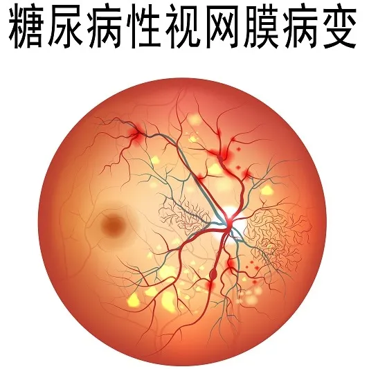 糖网病会对糖尿病患者带来什么伤害