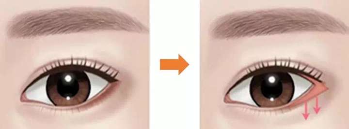 做眼睑下至是什么样的体验