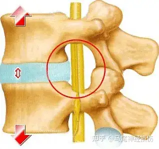 中老年人由於年齡原因不可避免的存在腰椎間盤的退行性變化(也就是