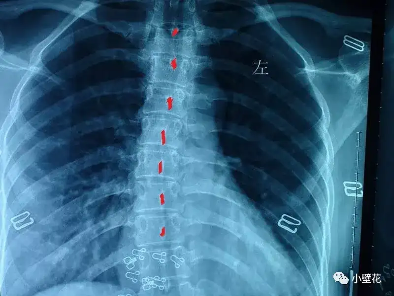 形体教室上肢篇 胸椎 知乎