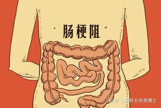 肿瘤患者肠梗阻怎么办？试试内科治疗的“6字方针”
