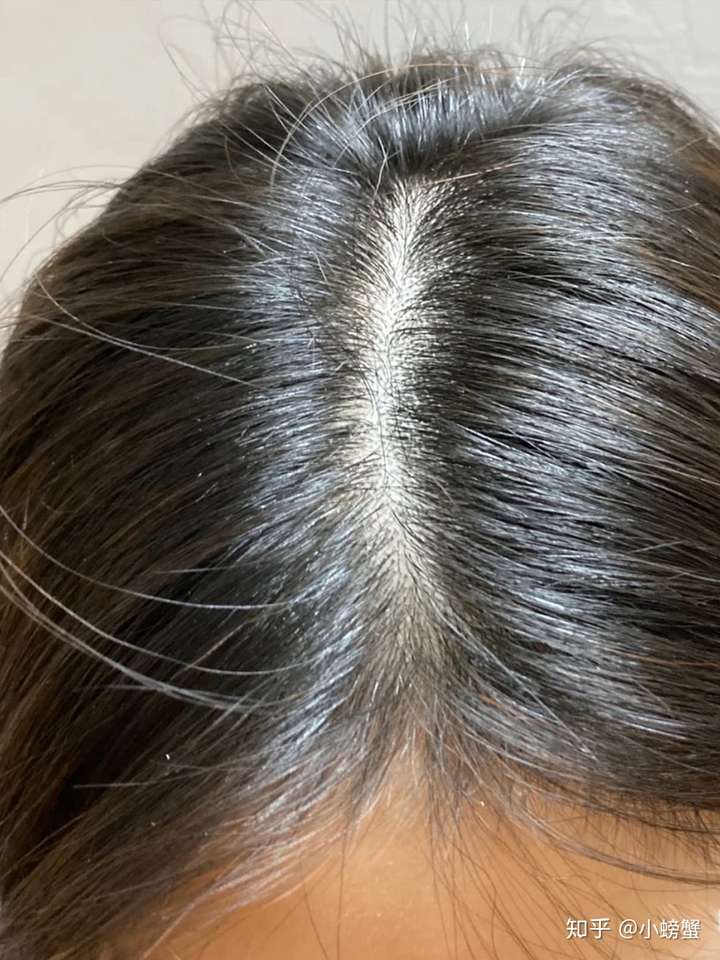 你们脱发最终是怎么好的?