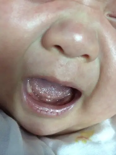 1个月婴儿牙床正常图图片