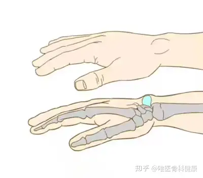 腱鞘囊肿会癌变吗?关于「腱鞘囊肿」,你要知道的 5 点