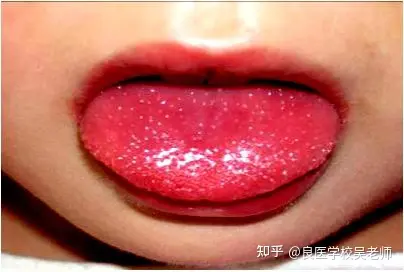 宝宝杨梅舌舌头图片图片
