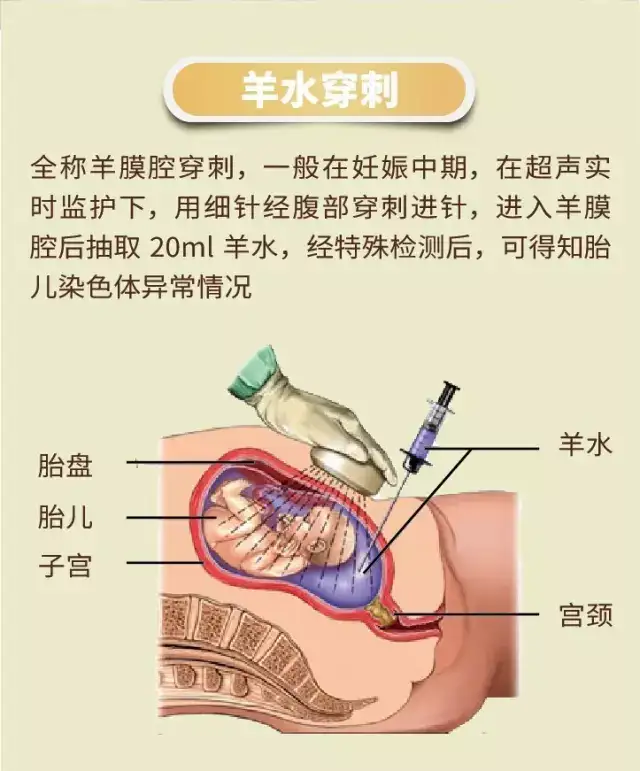 羊水穿刺风险图片