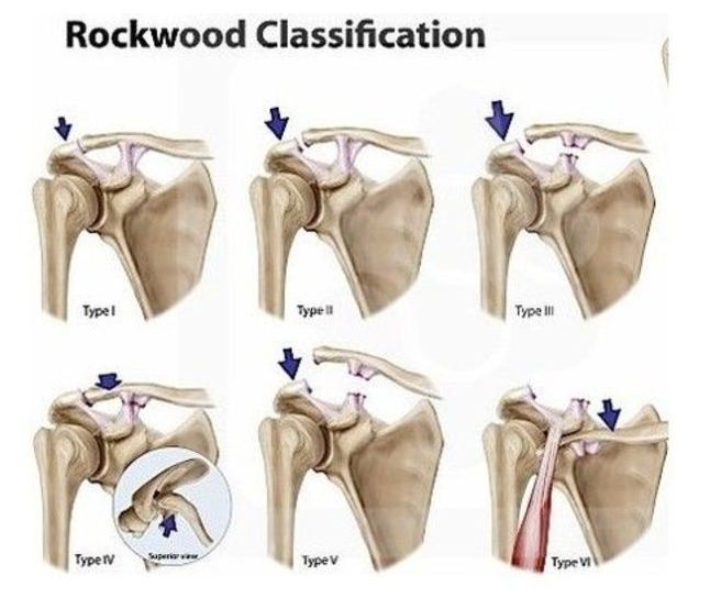 肩锁关节韧带损伤怎么恢复
