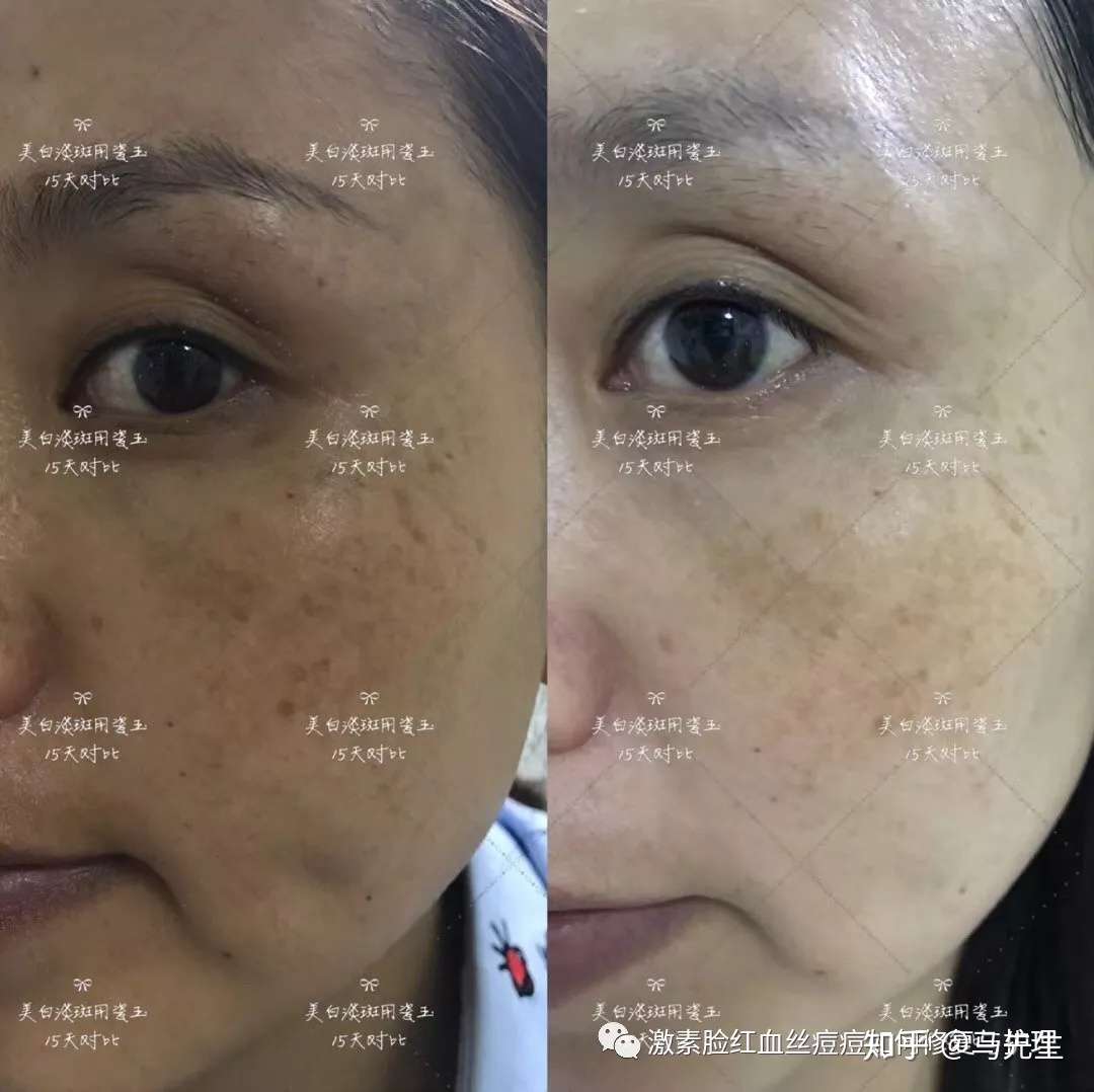 海英 什么是色素沉着 如何预防治 知乎