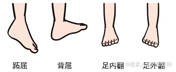 跟腱断裂手术后一年应该如何恢复