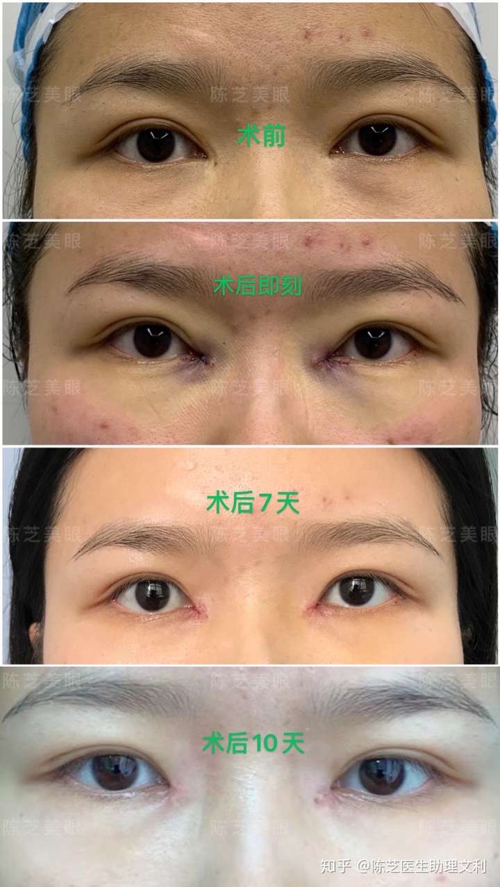 美女来自深圳,做过两次全切双眼皮 开内眼角,术后内眼角过大,括号疤痕