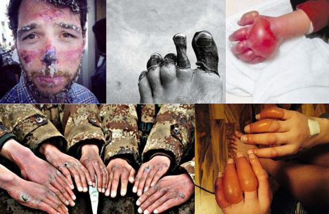 冻伤是什么样的有什么伤害