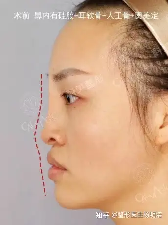 扒一扒那些年被山根害过的通天鼻