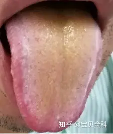 常见舌苔之黄腻苔