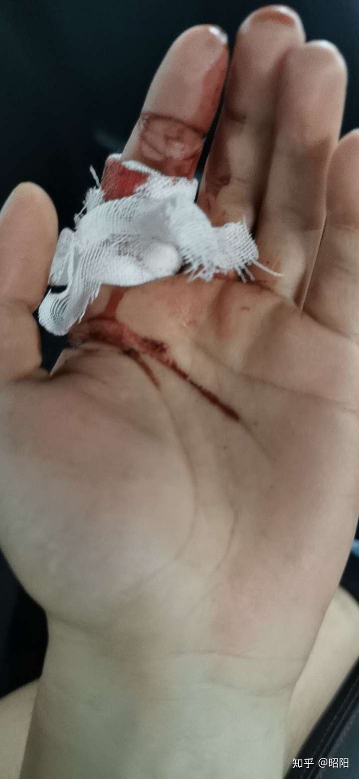 打篮球受过最严重的伤是什么?还在坚持打球吗?