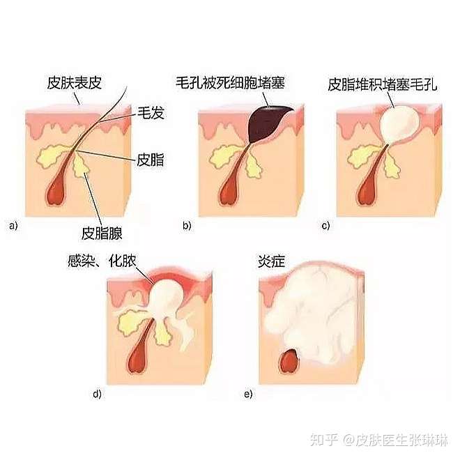 皮肤医生告诉你 黑头如何有效改善 知乎