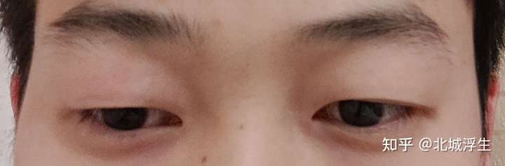 眼睛一高一低该怎么办?