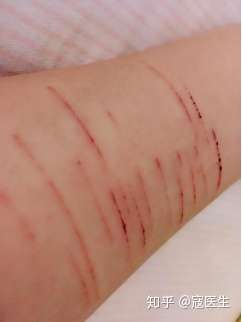 并且有过自残行为的人很大可能上形成自残成瘾,导致身体伤口不断,旧伤