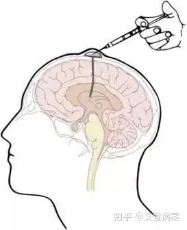 ommaya储液囊是一种脑室引流装置, 是由一个埋在头皮下的扁平状储液器