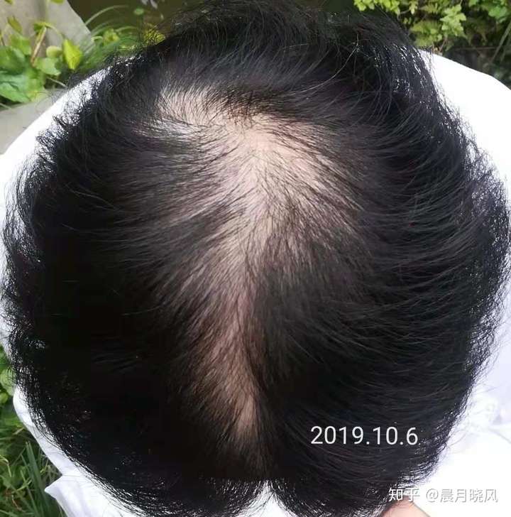 脂溢性脱发该怎么办?