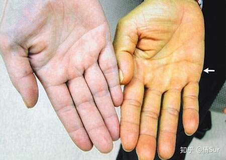 vn    右侧的手掌就是胡萝卜素血症的患者