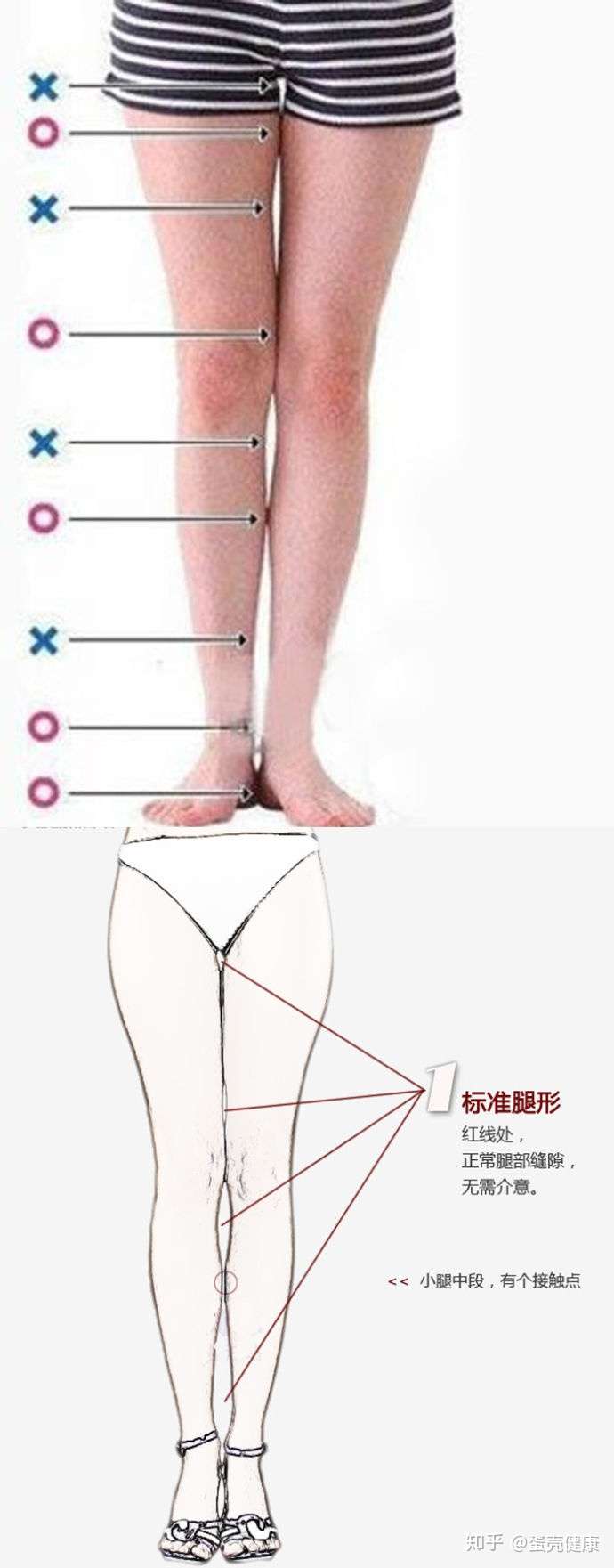 如何矫正罗圈腿(o型腿)?
