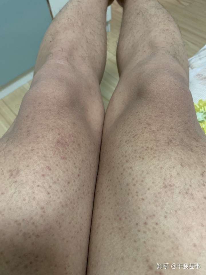 男朋友会不会嫌弃女朋友一身鸡皮肤