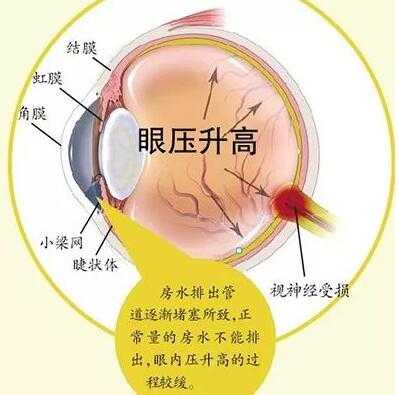 眼壓高是什麼原因造成的? - 知乎