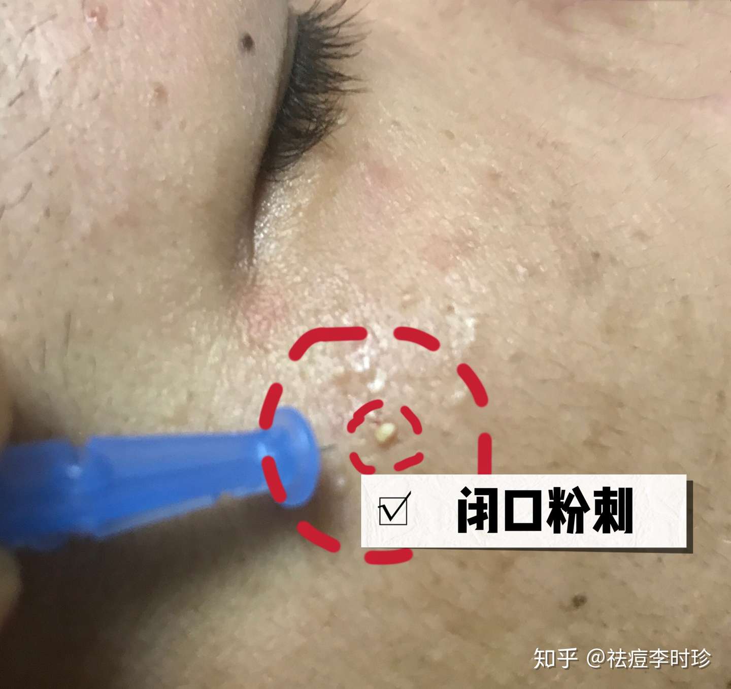 闭口 粉刺 痘痘 需要针清吗 知乎