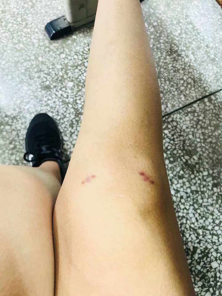 半月板手术的前期 过程以及后续以及半月板损伤的心路历程 知乎 半月板手术的前期 过程以及后续以及半月板损伤的心路历程 知乎