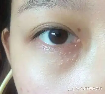 它是一种形成于毛囊皮脂腺的表皮囊肿,内部聚集了角质化的残留物,通常