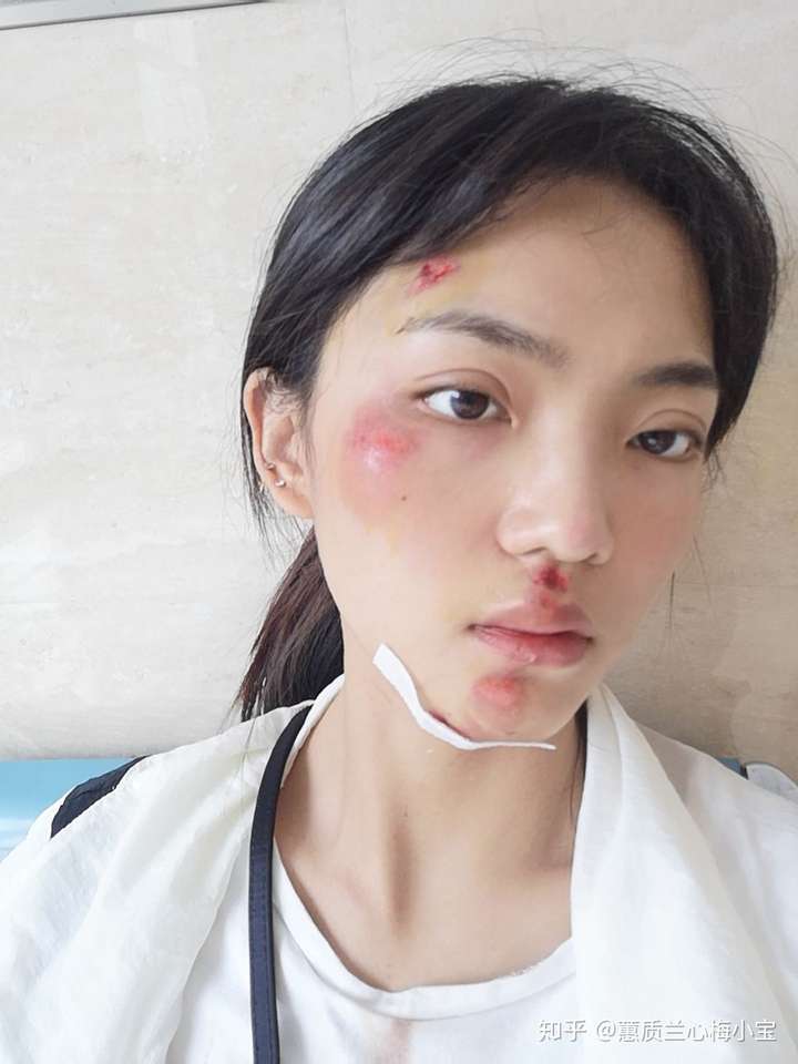 骑车摔伤面部手膝盖等如何处理不留疤