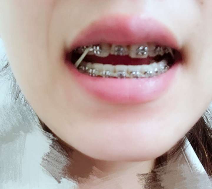 戴牙套是什么体验?