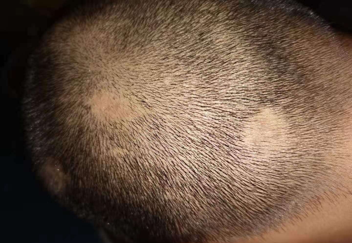 毛发医生李世涛 的想法: 发生斑秃一般最主要的原因是心理压力过大