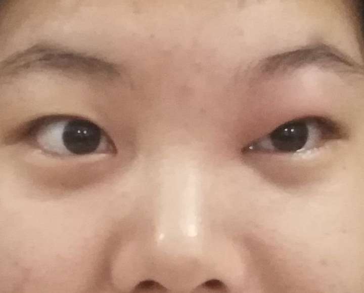 眼睛被蚊子叮了,如何快速消肿?