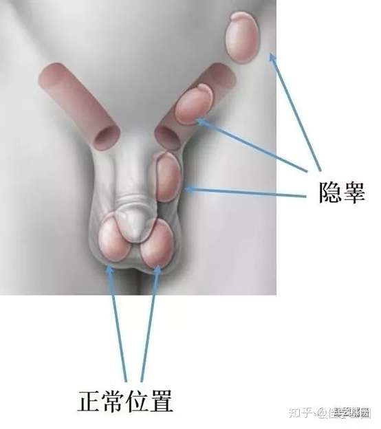 隐睾丸基因解码 基因检测 知乎